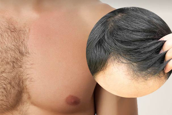 Vücud Kıllarından Saç Ekimi Mümkün mü ?