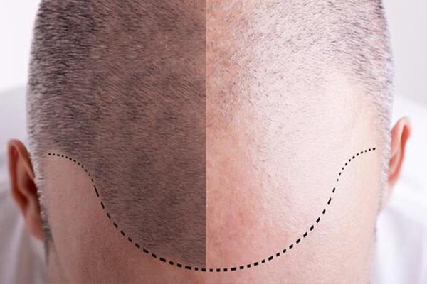 DHI-SAC-EKIMININ-AVANTAJLARI-