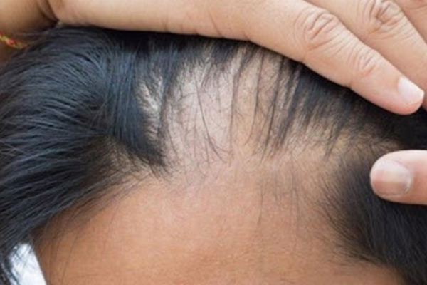 Dhi-Fue-Sakal-Ekimindeki-Sonuc-ve-Iyilesme-Suresi-Ne-kadardir-